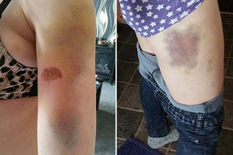 composite-laureninjury