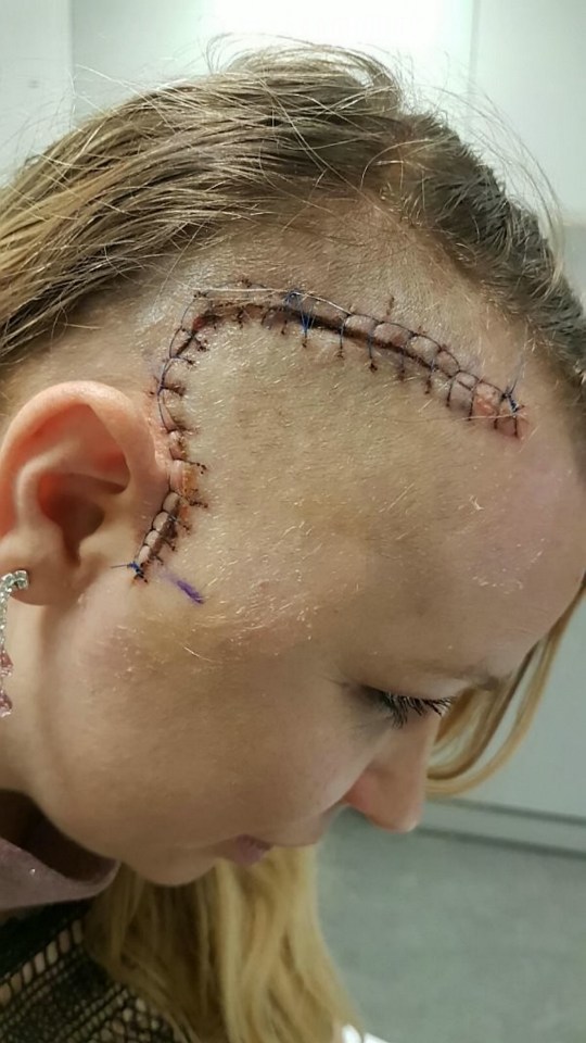 brain tumour student