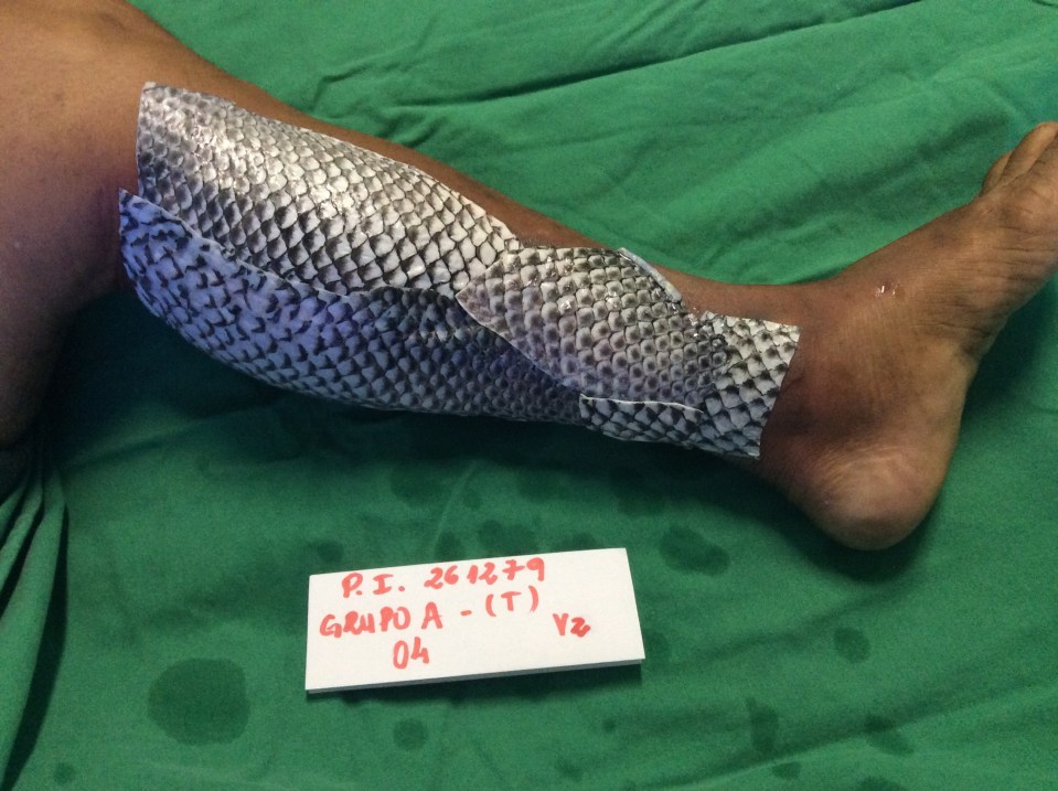 Doctors covered the man's injuries in fish skin to soothe the wounds