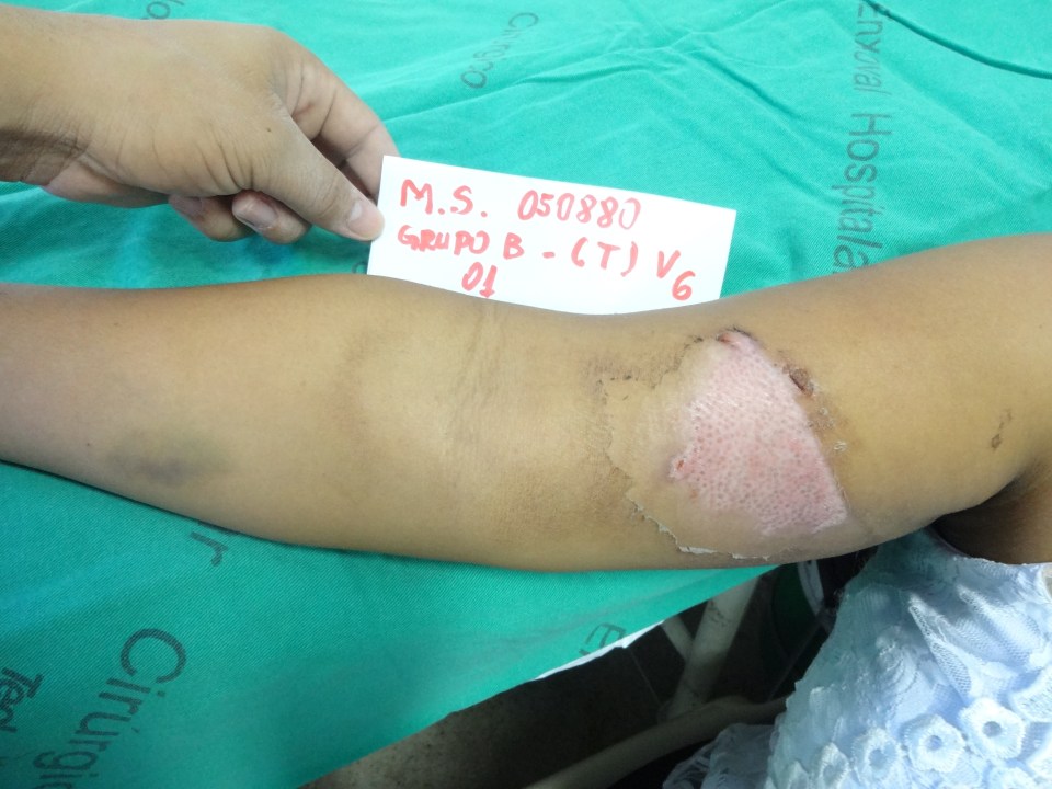 Maria says she loved the treatment and would recommend it to other burns victims