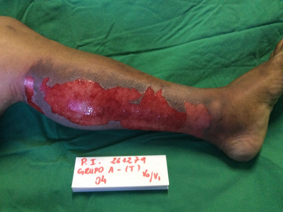 Another patient with second degree burns on his leg also underwent the new treatment