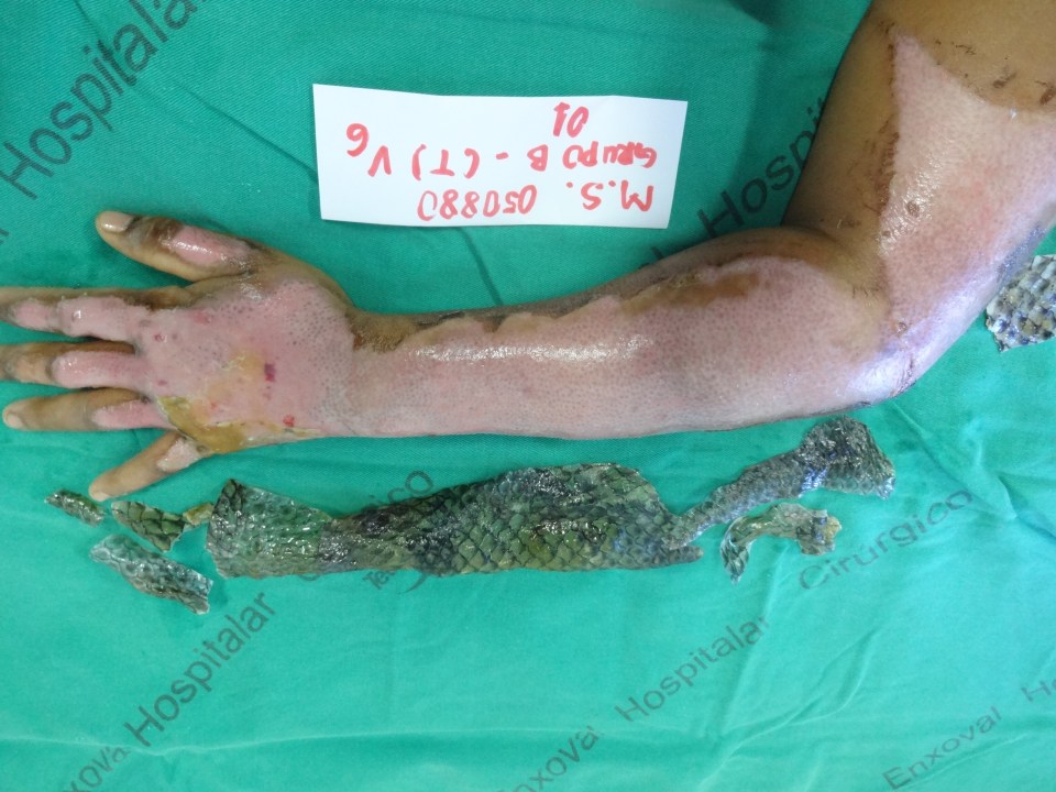 Burns victim Maria Ines Candido da Silva is one of the first patients to be treated using the skin on a Tilapia fish, after she suffered horrific burns in an explosion. Her arm is pictured after treatment once the fish skin was removed