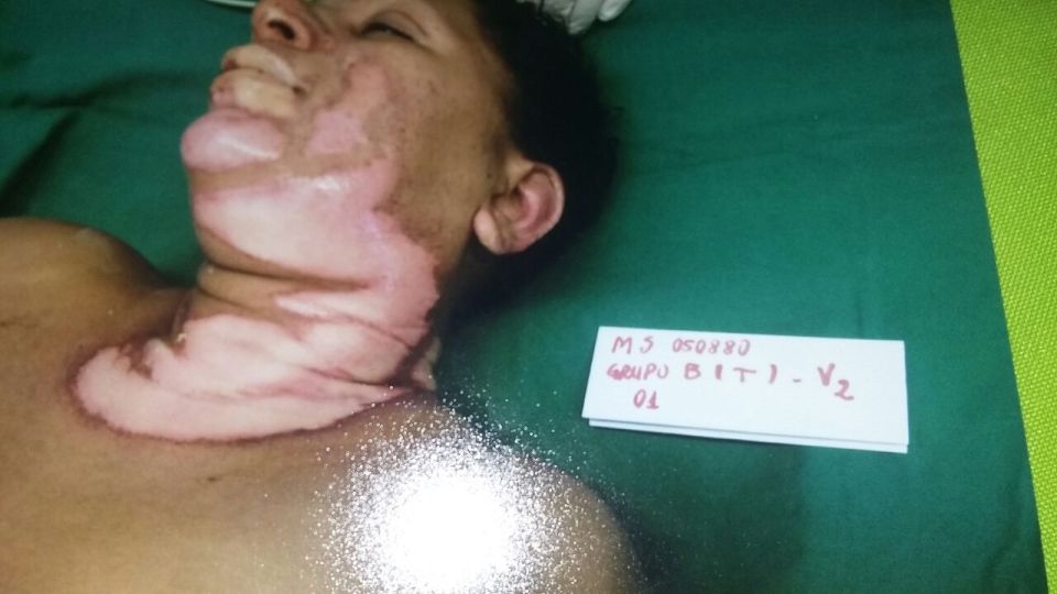The fish skin helped to heal the wounds on Maria's body