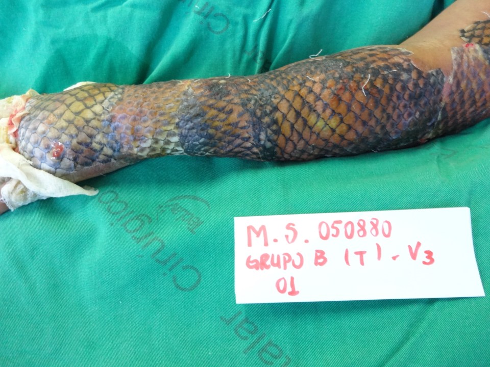 Pioneering treatment: Brazilian doctors are spearheading a new treatment for burns victims using the skin of a tropical fish