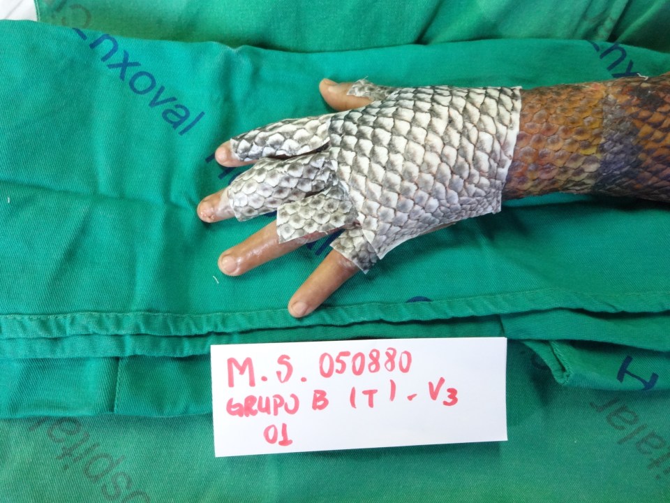 Doctors left the fish skin on Maria's left hand for longer as the wounds were deeper