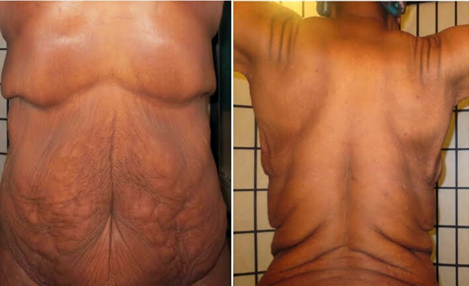 weight loss