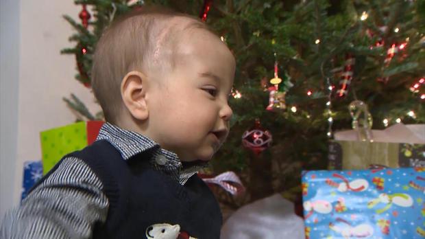  Vincent Bono was born with a type of craniosynostosis, a rare birth defect and needed pioneering treatment