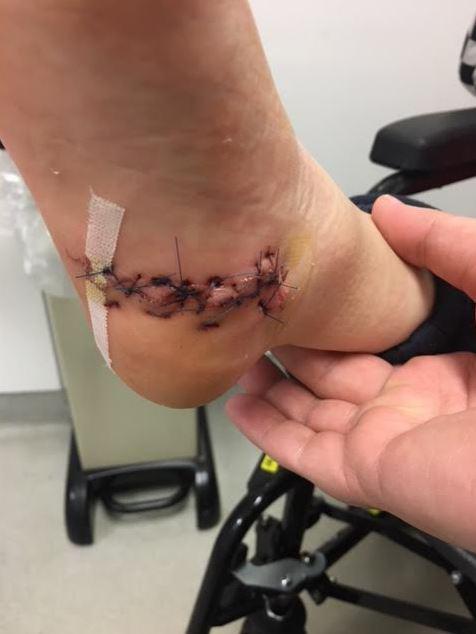 The pastry mould left a deep gash in the boy's foot