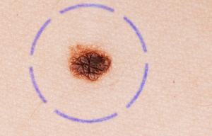 New drug 'STOPS the deadliest form of skin cancer spreading' - and could save thousands of lives