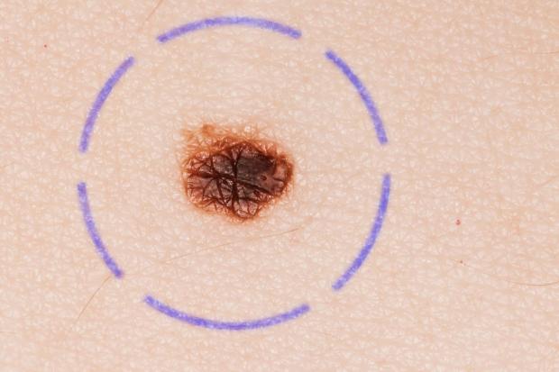 Melanoma is the most dangerous form of skin cancer, largely because it tends to spread to the brain and lungs