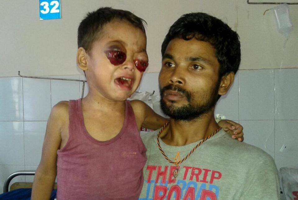  Sagar has been cured of the cancer that made his eyes bleed
