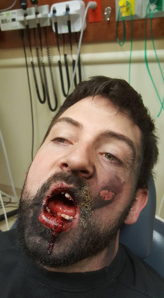 Andrew Hall has been left in utter agony after the vape explosion tore into his face