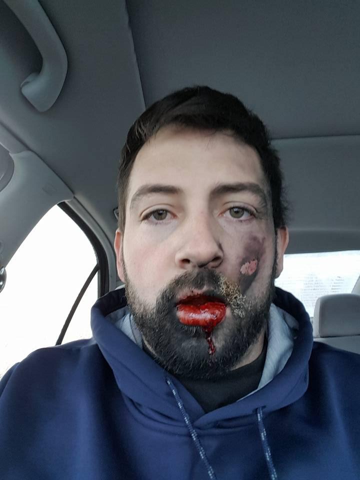 As well as losing teeth and having his face burned, there is internal damage to his mouth so he struggles to eat