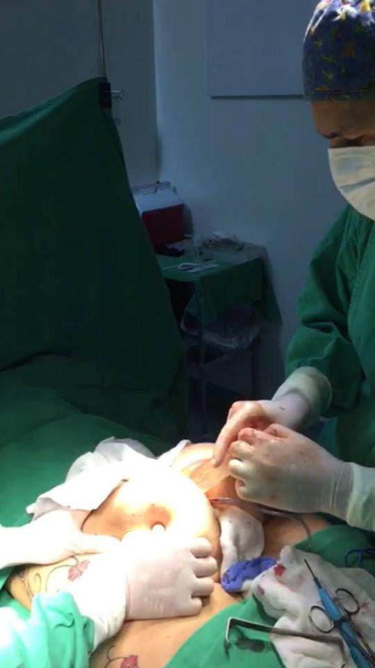  Gilliane decided to go under the knife to remove silicone implants