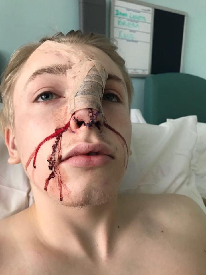 Aiden Noel, 19, was left with shocking injuries after he was attacked by a dog 