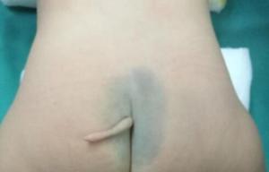 A five-month-old baby girl has undergone an op to have her tail removed