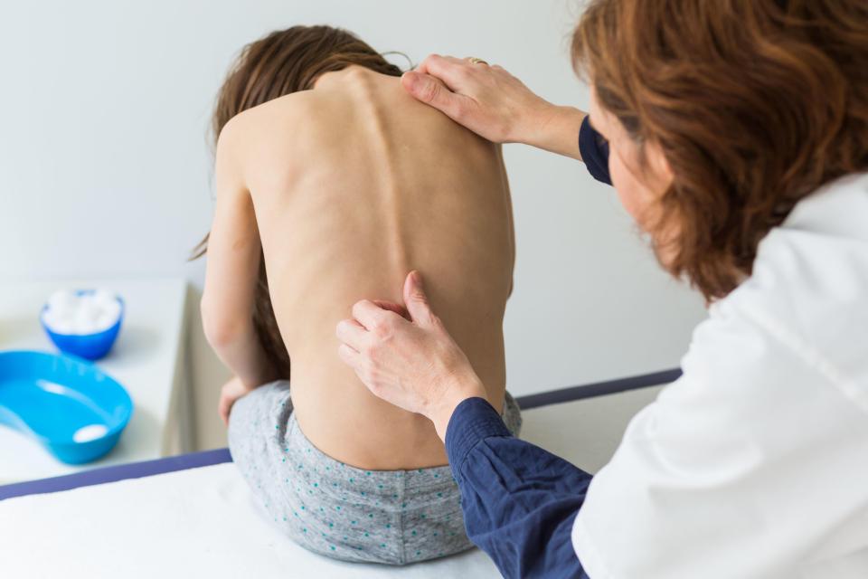  Even though scoliosis requires treatment to straighten the spine, surgery isn't always prescribed