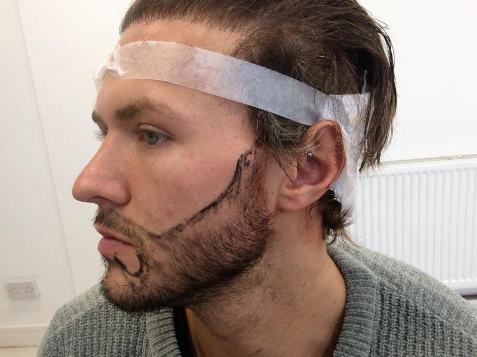  The Geordie Shore star recently had a beard transplant
