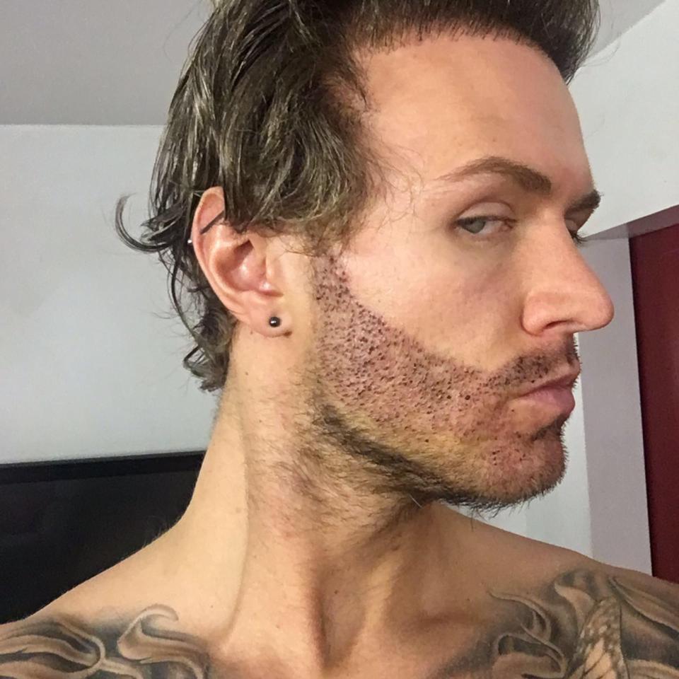  Kyle revealed the finished results of his beard transplant