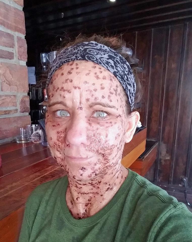 Libby pictured two days after having electrodessication, a pioneering op to remove the tumours