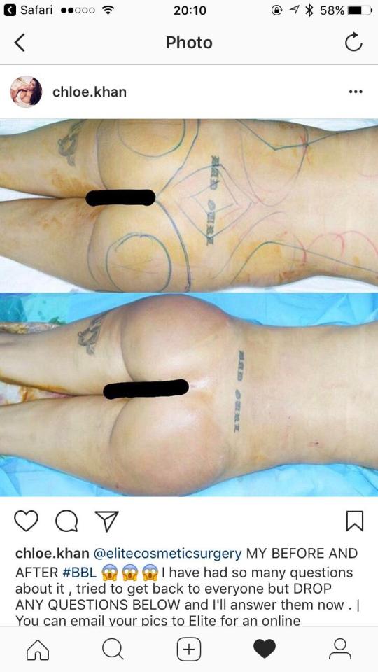  The former webcam model posted a dramatic before and after comparison of her bum pre and post surgery
