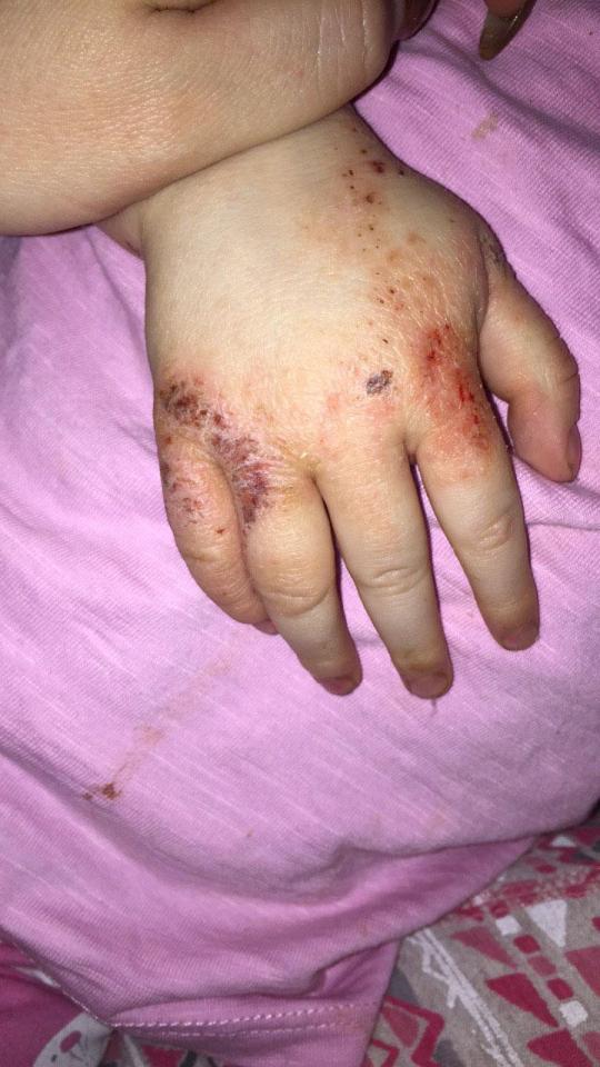 Before using the Childs farm baby moisturiser Evie's hands were covered in painful scabs from her eczema