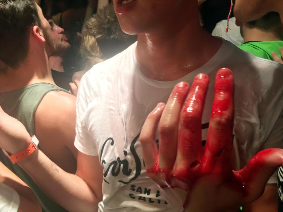 Party-goer with a badly cut, bleeding hand in Bananas club