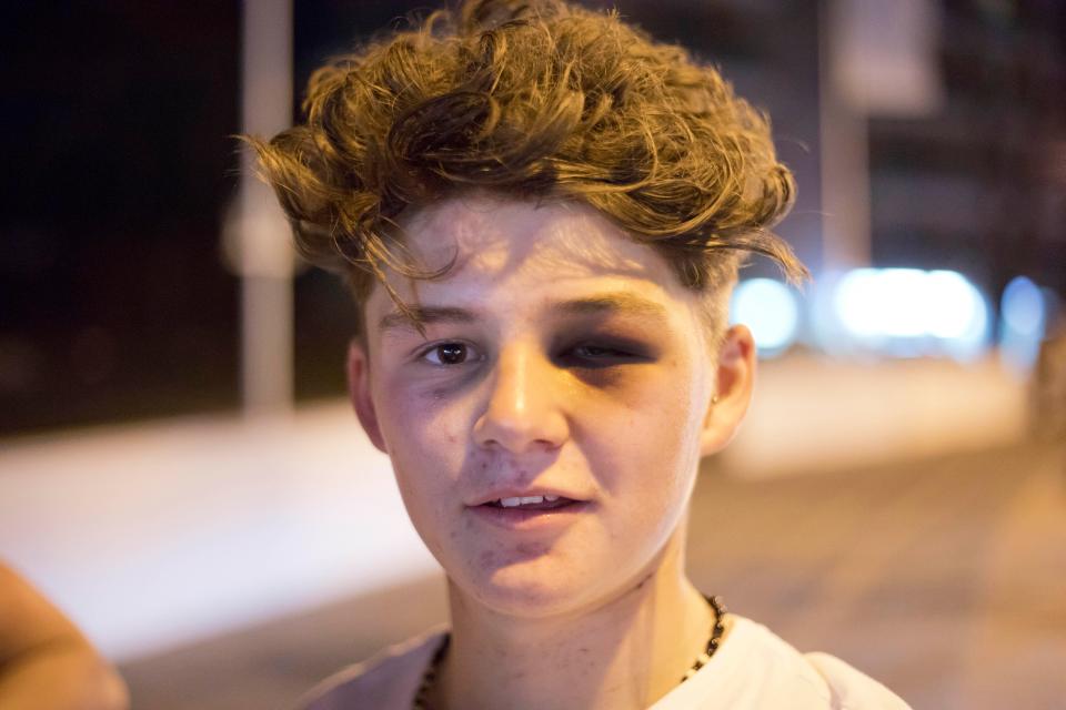 Teenager Jordan Thomas had his eye battered after an altercation with Spanish authorities 