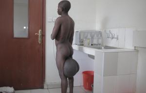 The 21-year-old first noticed a cyst on his genitals in 2006, and despite one op they grew so big he could barely walk