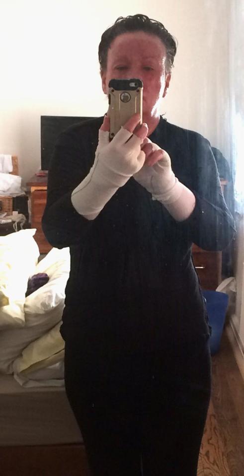 Juli-Anne no longer uses steroid creams every day but still has to bandage her skin to protect it