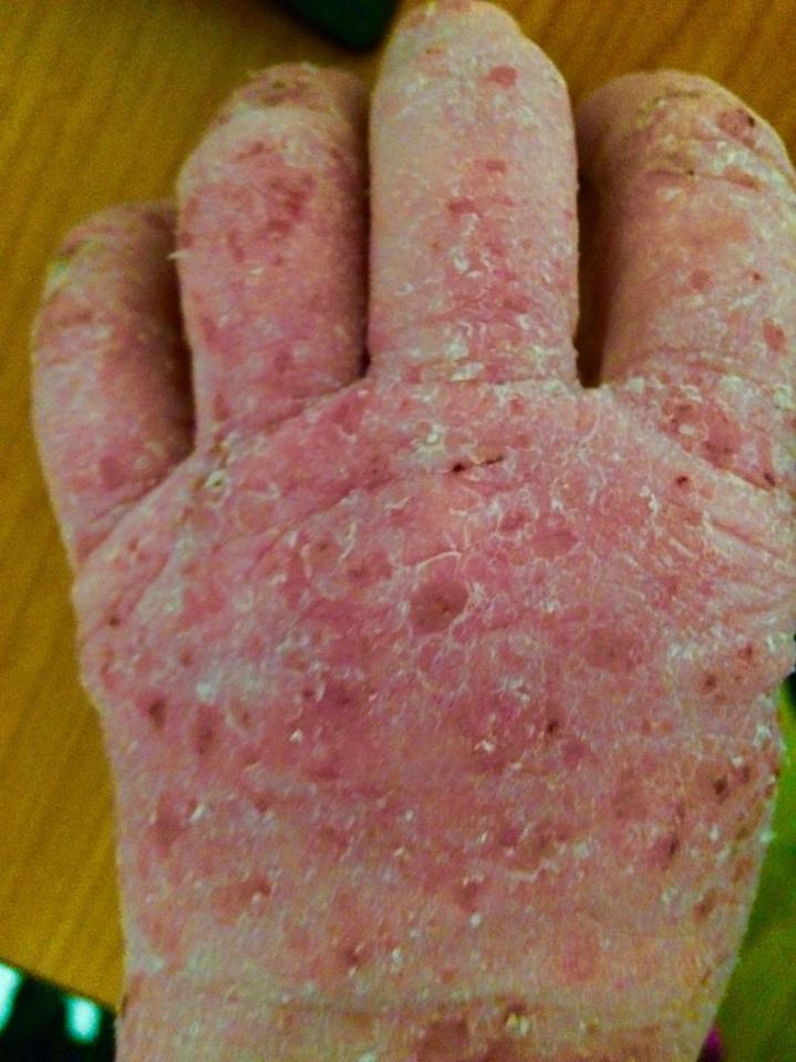 Juli-Anne said the condition left her 'looking like a burns victim'