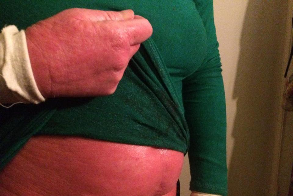 Juli-Anne's skin would flare up and become red raw if she stopped using steroid creams