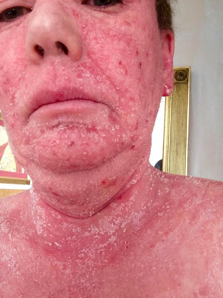 Juli-Anne became addicted to steroid creams which left her skin red and flaky if she stopped using them