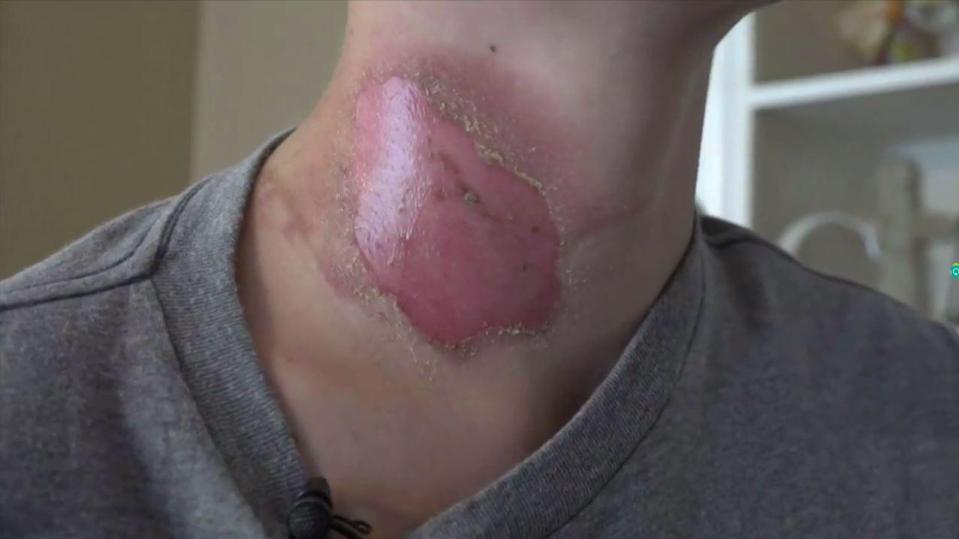  The teenager's wound is starting to heal and he says the boys who burned him are not his friends anymore