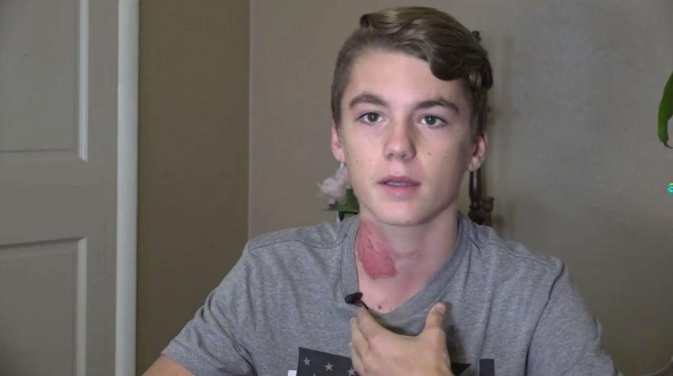  A teenager was left with first and second degree burns when his friends threw boiling water on his neck as part of the sick Hot Water Challenge