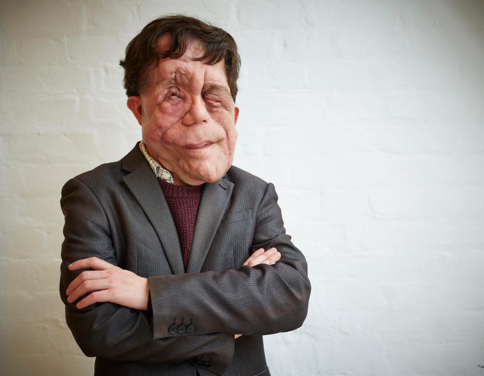  Adam Pearson has appeared on many TV shows
