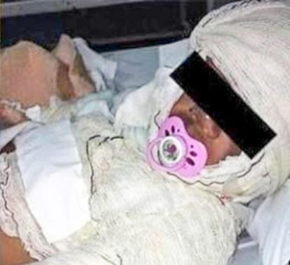 One of the injured children is seen wrapped in bandages after being set alight 