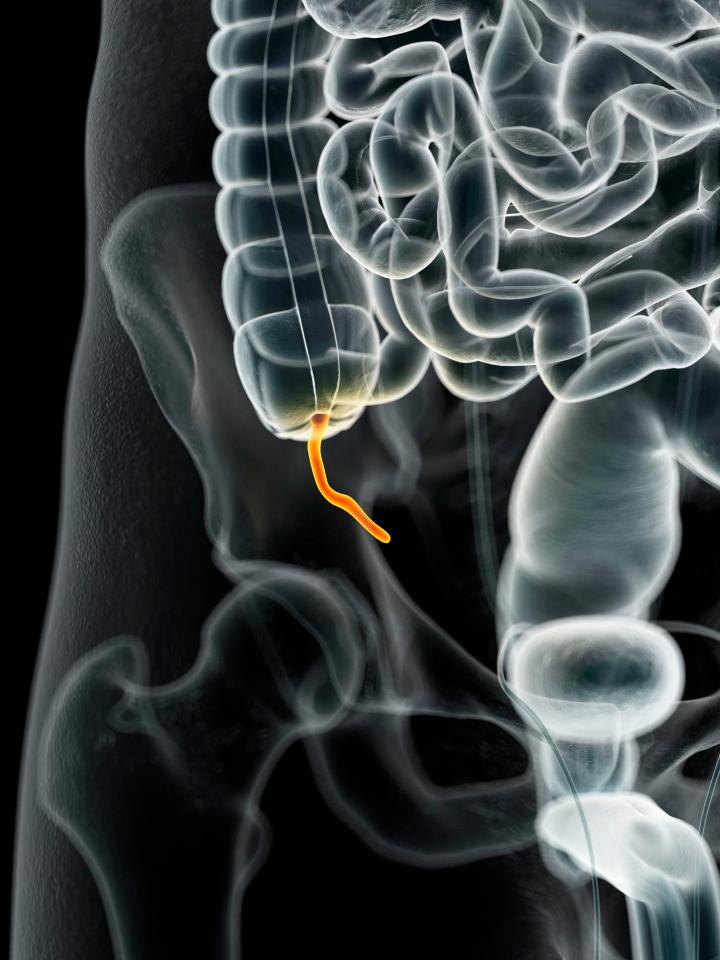 The appendix is often removed when it becomes inflamed, causing appendicitis