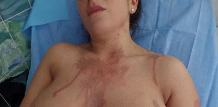  Phoebe told how she desperately doused herself in water to try and stop the agonising pain