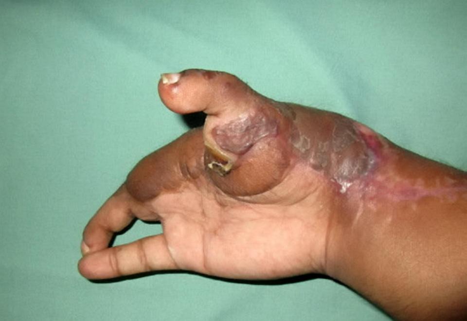 Sojan KM has had one of his toes transplanted on to his hand to create a new thumb after losing his in a bomb blast