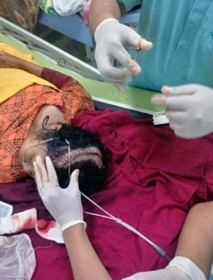  Pictures show her scalp being sewn back together by medics after being hit by the train
