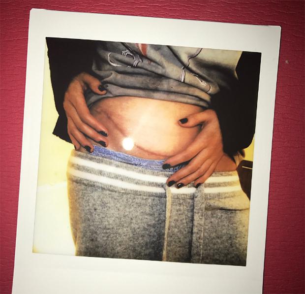  Selena was left with a stomach scar after having her kidney replaced