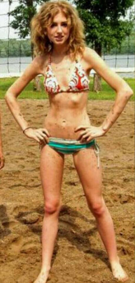  At her worst she had a body mass index of 14.5 - a healthy range lies between 18 and 25