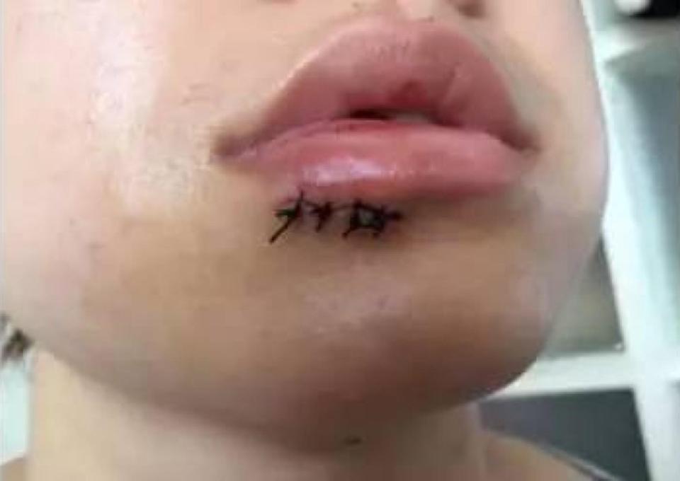  Ms Wang claims she needed stitches in her lip after the glass exploded