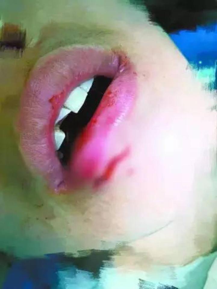  She says she was left with a cut lip and broken tooth