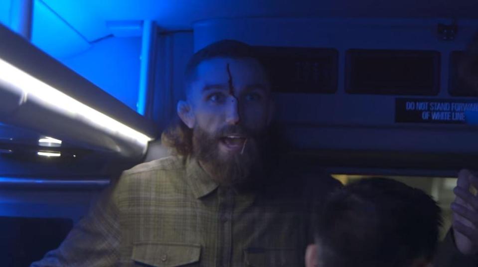  Michael Chiesa was left with a cut face after glass shattered onto his face