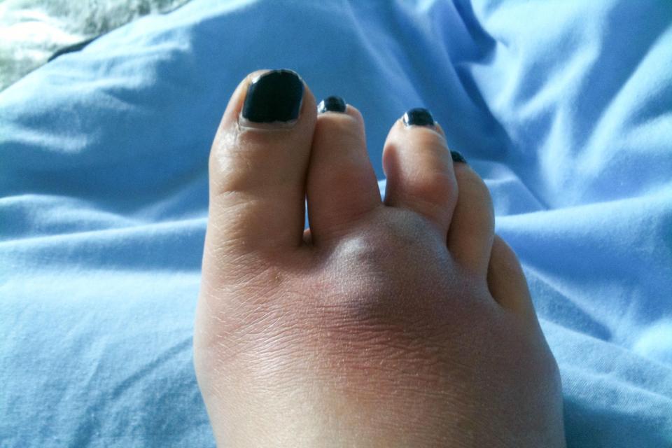 It took six years for Nicola's foot to finally heal