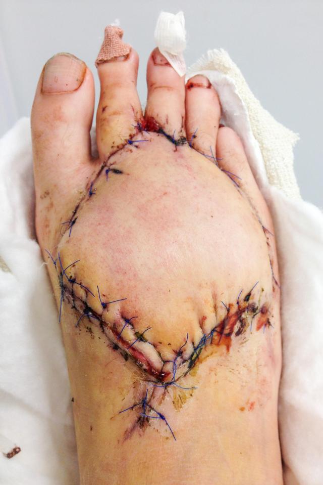The mum-of-three was diagnosed with the autoimmune disease after two years of pain, thinking she had been bitten by an insect