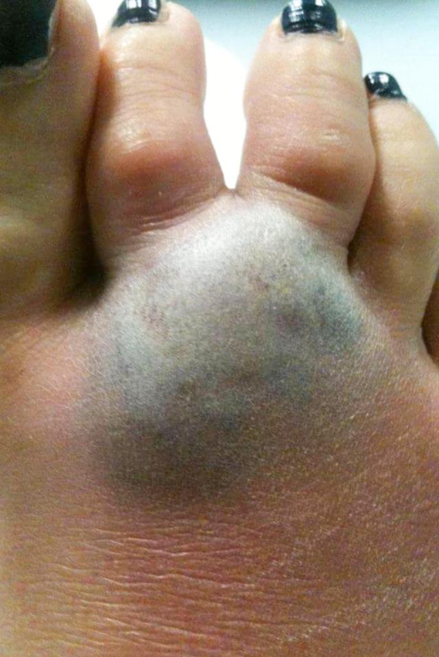 The 40-year-old had several ops to remove the infected tissue