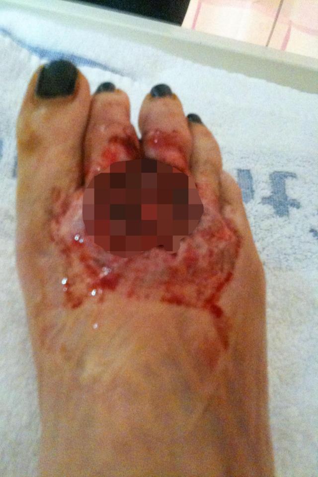 The condition left Nicola housebound, and caused tension between her and her partner, resulting in them splitting up